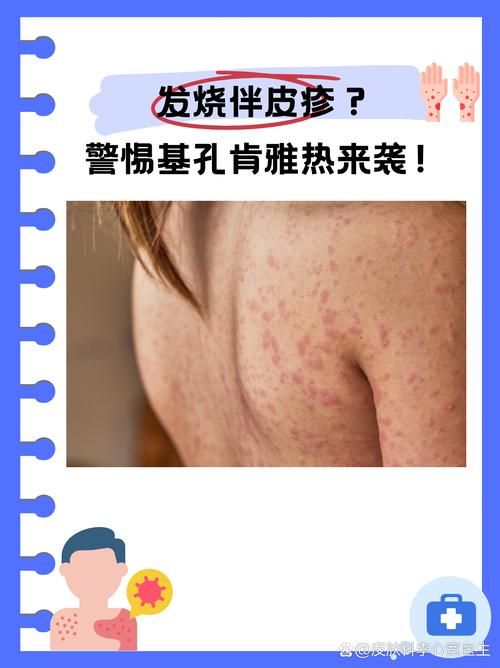 华南热作学院昨日新增无症状感染者22例_华南热作两院